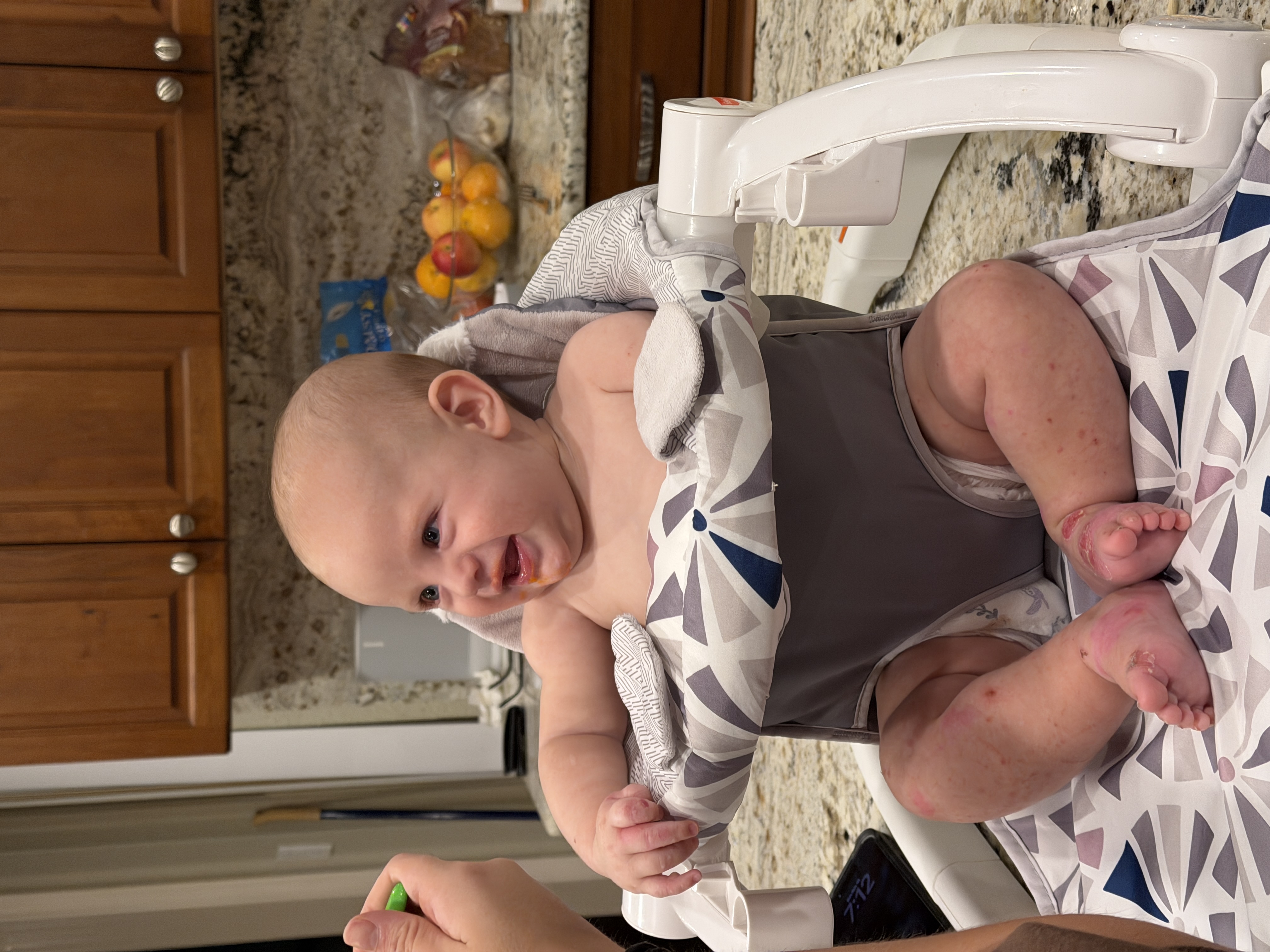 Epidermolysis Bullosa Personal Story