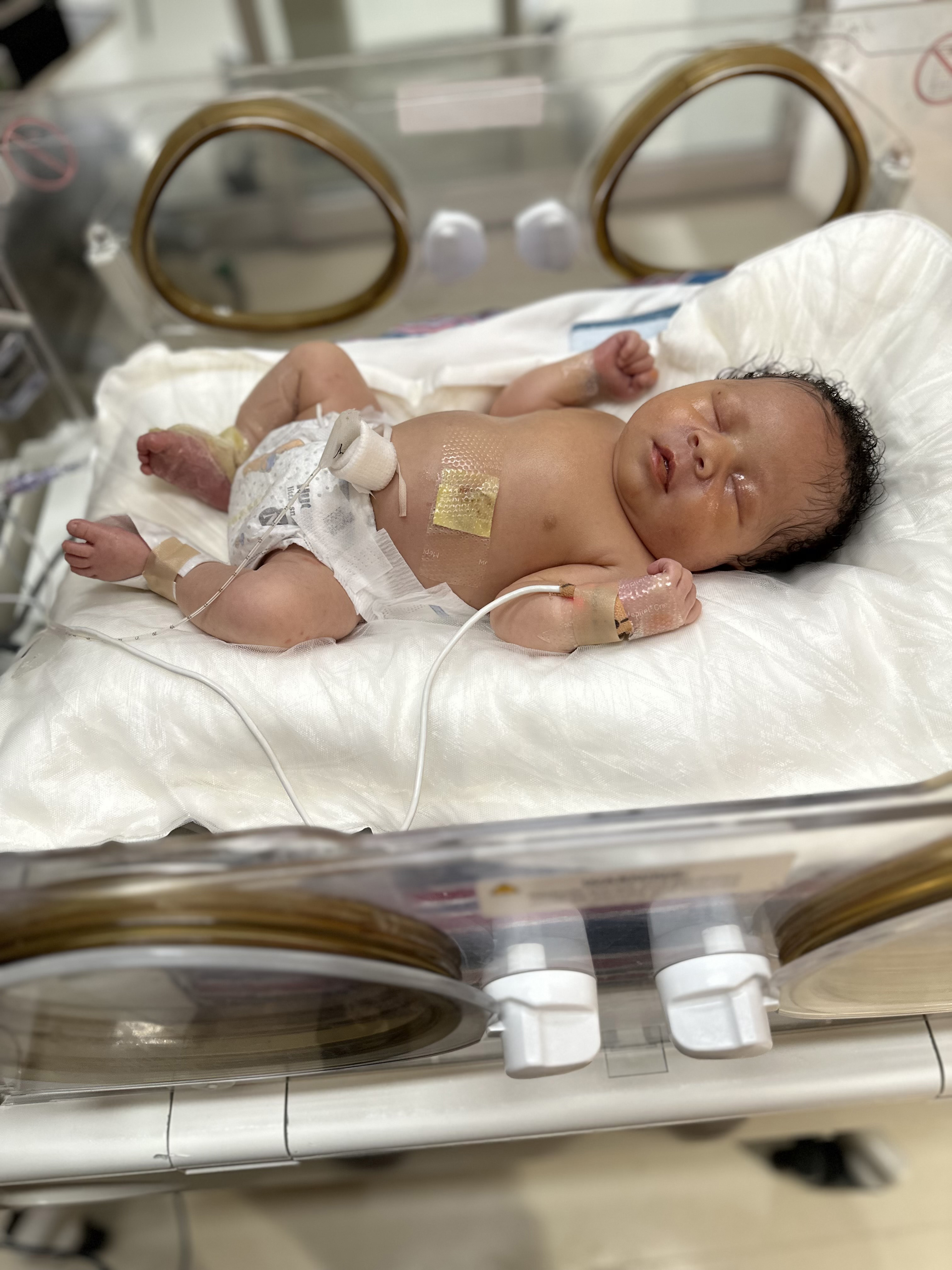 Alayah Epidermolysis Bullosa Story