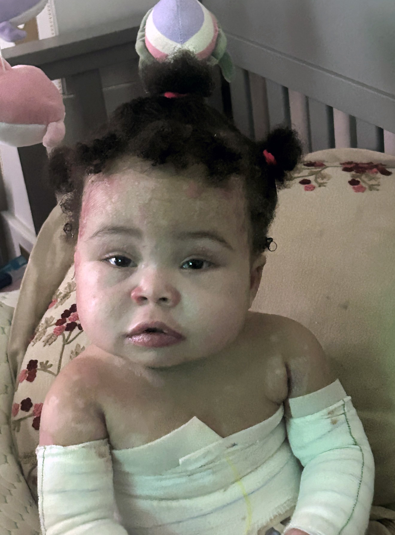 Alayah Epidermolysis Bullosa Story