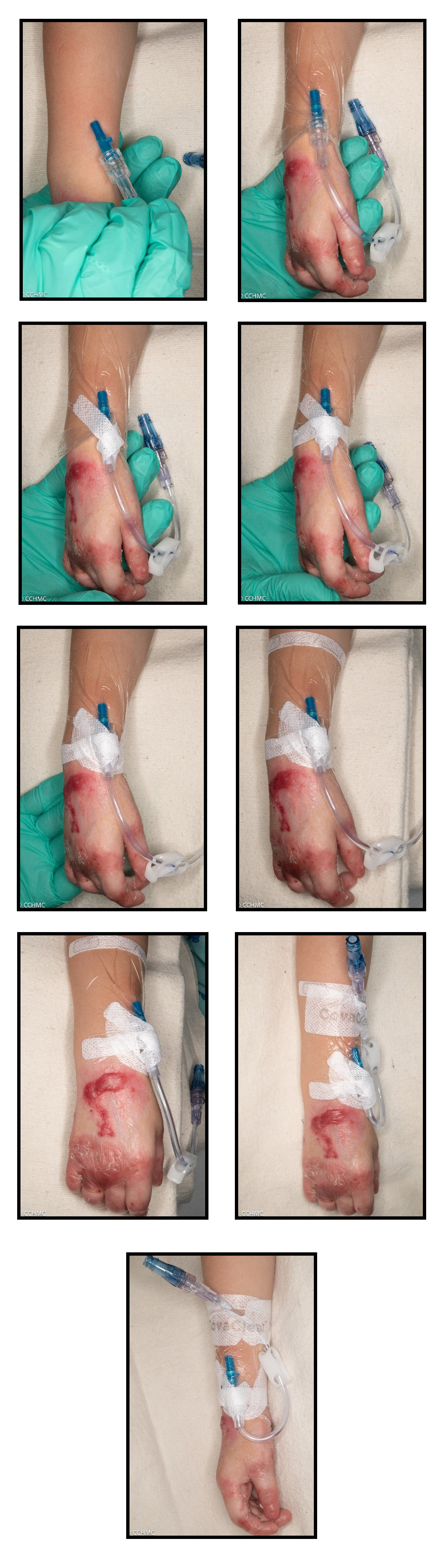 Catheter Securement