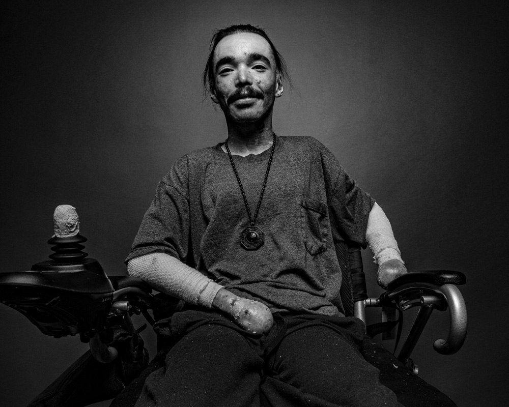 Dystrophic Epidermolysis Bullosa