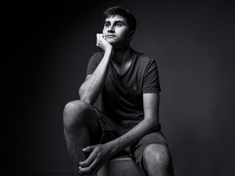 Epidermolysis Bullosa Simplex