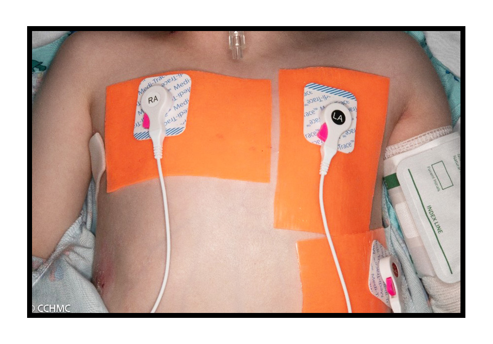 Heart Monitors EKG