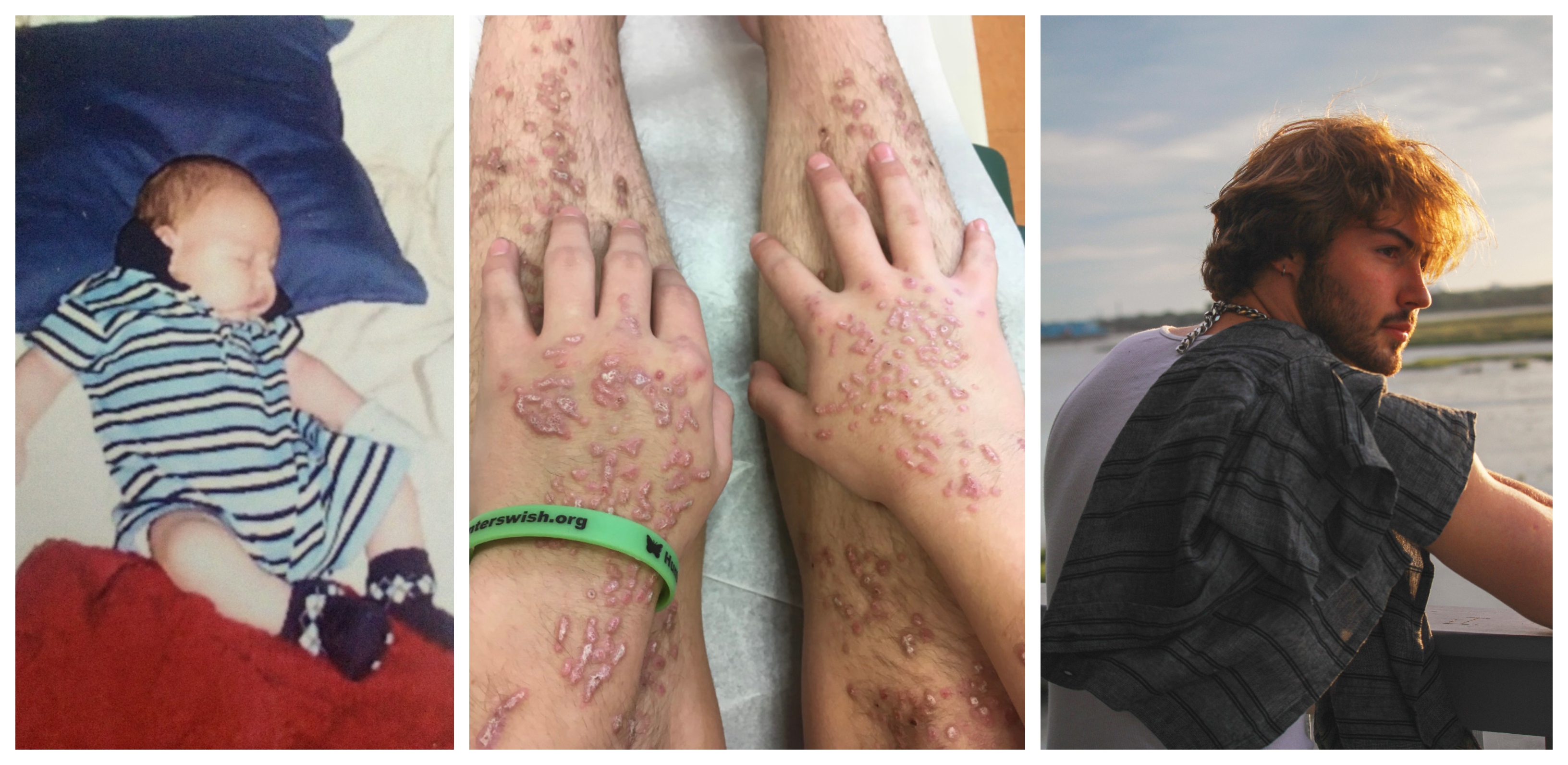Epidermolysis Bullosa Personal Story