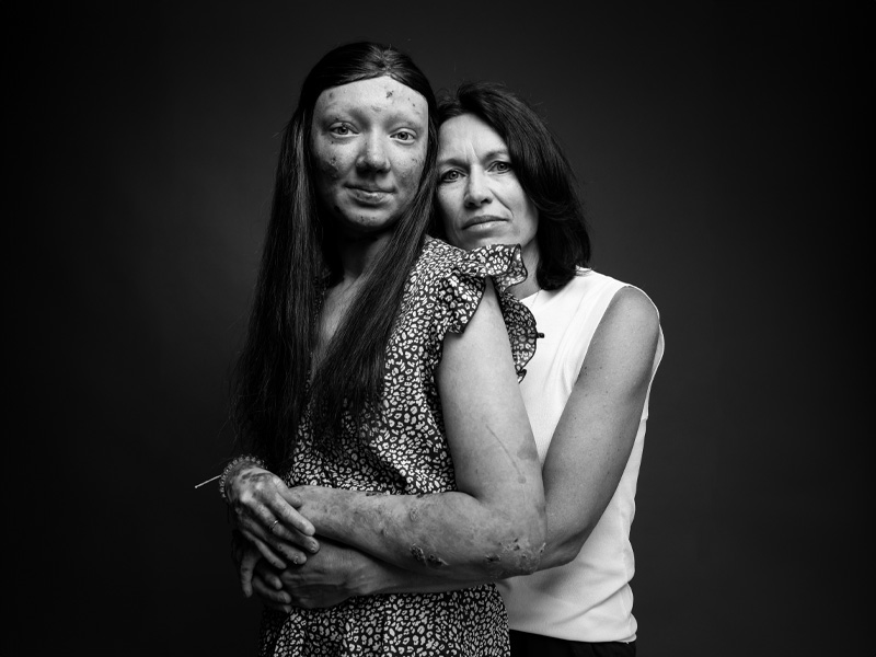 Junctional Epidermolysis Bullosa