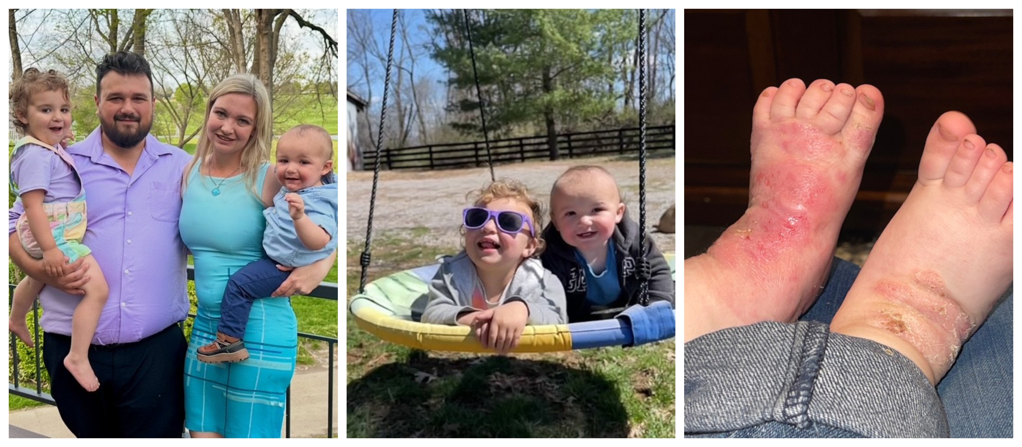 Epidermolysis Bullosa Personal Story